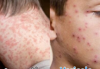 Gobierno del Estado refuerza Campaña informativa sobre sarampión y viruela